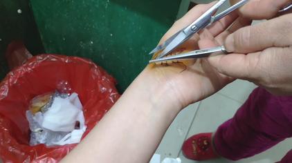 手掌缝针几天可以拆线 - 西瓜视频