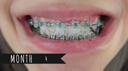 带牙套牙齿变黑 西瓜视频